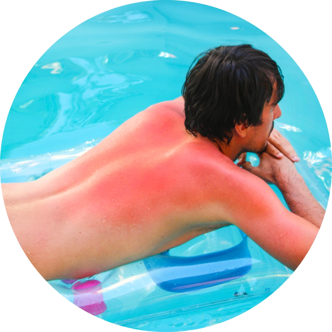 Verbrennungen & Verätzungen