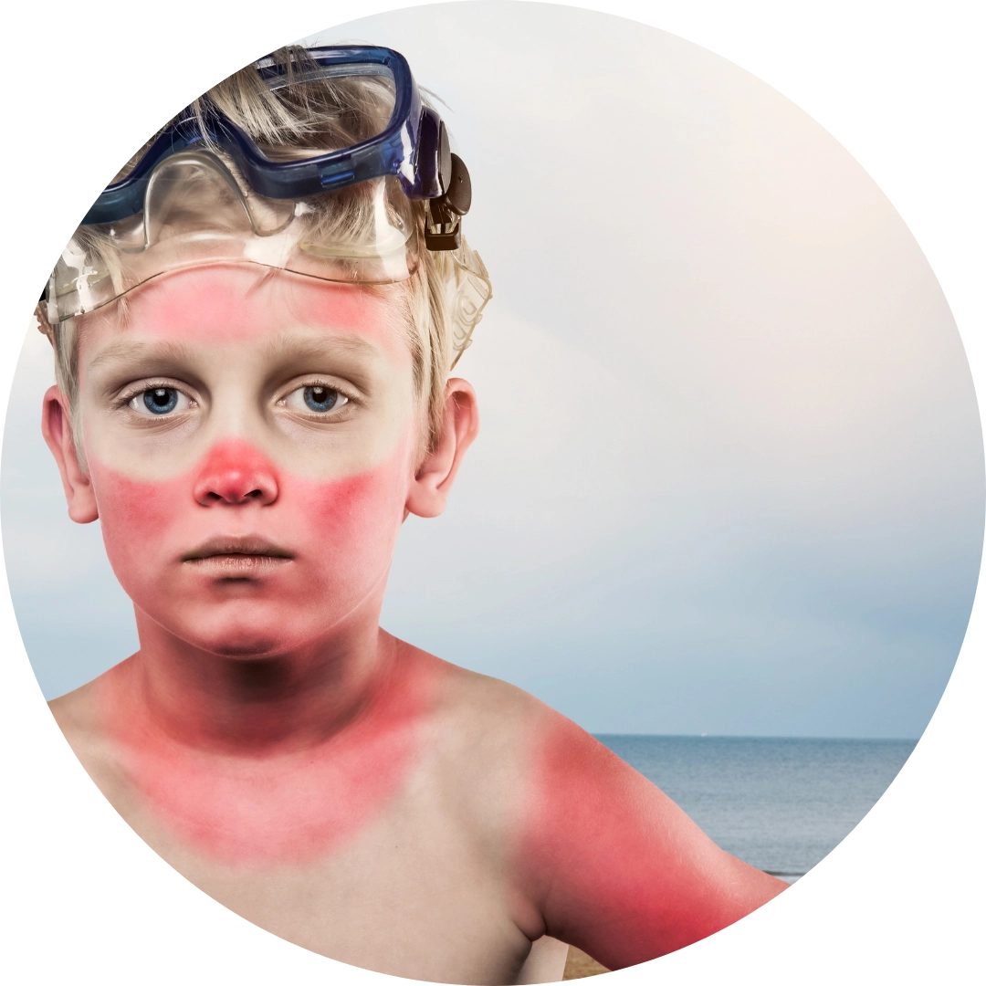 Verbrennungen & Verätzungen